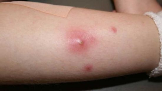 Trị bệnh mụn nhọt bằng cây an xoa