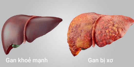 viêm gan, xơ gan